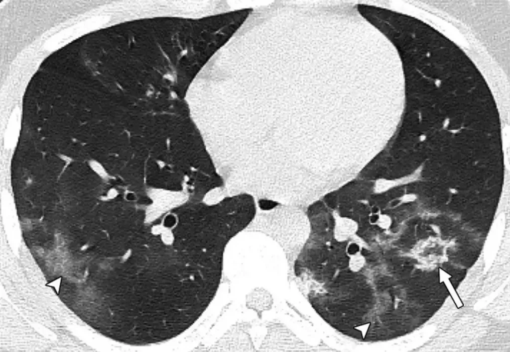 Συγκλονιστική ανάρτηση Μαγιορκίνη: Άγνωστο τι θα προκαλέσουν οι βλάβες  στα πνευμόνια ανηλίκων  που νόσησαν από κορωνοϊό