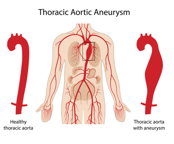 Διακαθετηριακή αντιμετώπιση ανευρυσμάτων