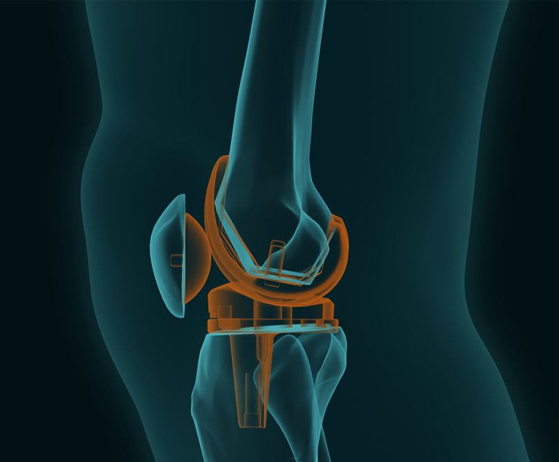 Τι ισχύει για την αρθροπλαστική γόνατος και ισχίου