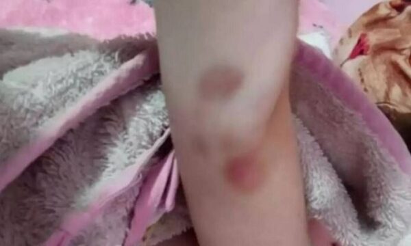 Πάτρα: Φωτογραφία – ντοκουμέντο με μελανιές στο χέρι της Τζωρτζίνας