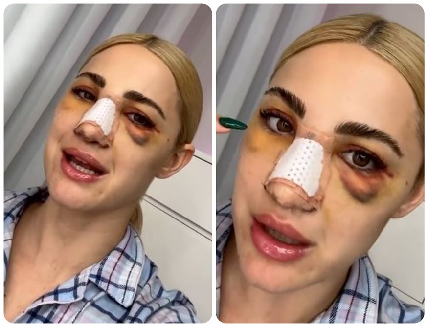 Ιωάννα Τούνη: Έτσι είναι το πρόσωπό της τρεις μέρες μετά την πλαστική στην μύτη