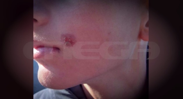 Σοκ στην Πέλλα: 15χρονος επιτέθηκε σε 14χρονο συμμαθητή του και του έσβησε τσιγάρο στο πρόσωπο