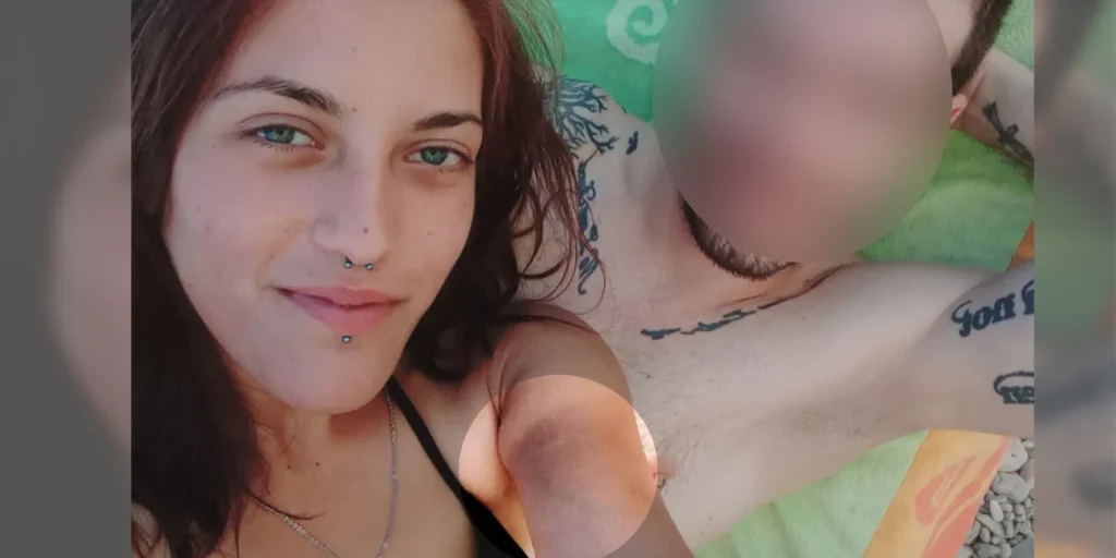 Άγιοι Ανάργυροι:  Φωτογραφία-ντοκουμέντο της 28χρονης Κυριακής με μελανιές στο χέρι – « Ο δράστης είχε επιτεθεί και σε άλλη γυναίκα»