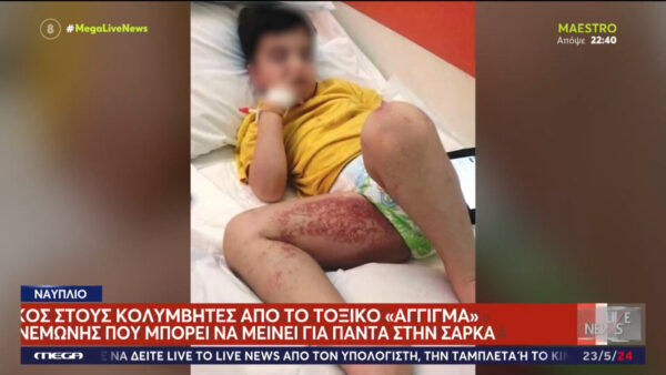 Ναύπλιο: Θαλάσσιες ανεμώνες τσίμπησαν παιδιά σε παραλία – Επικίνδυνο το τσίμπημα λένε οι γιατροί
