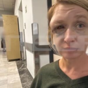 Κορωπί: Σοκάρει η εικόνα της 40χρονης που ξυλοκοπήθηκε – «Δεν πιστεύω ότι μου επιτέθηκε ο σύντροφός μου, έχουμε σχέση αγάπης,  μπορεί οι γείτονες» λέει